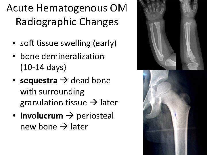 Acute Hematogenous OM Radiographic Changes • soft tissue swelling (early) • bone demineralization (10