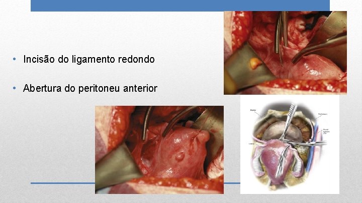  • Incisão do ligamento redondo • Abertura do peritoneu anterior 