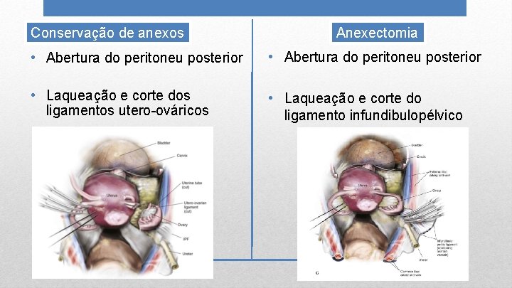 Conservação de anexos Anexectomia • Abertura do peritoneu posterior • Laqueação e corte dos