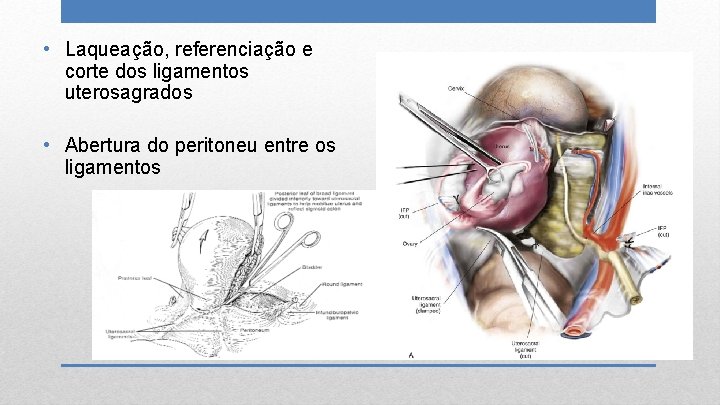  • Laqueação, referenciação e corte dos ligamentos uterosagrados • Abertura do peritoneu entre