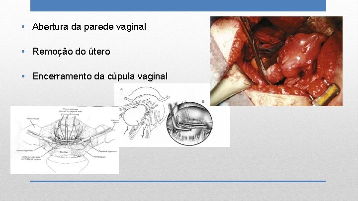  • Abertura da parede vaginal • Remoção do útero • Encerramento da cúpula