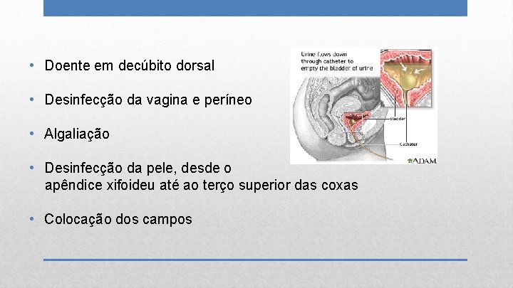  • Doente em decúbito dorsal • Desinfecção da vagina e períneo • Algaliação