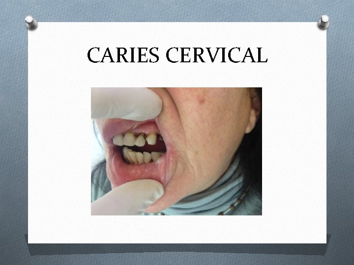 CARIES CERVICAL 