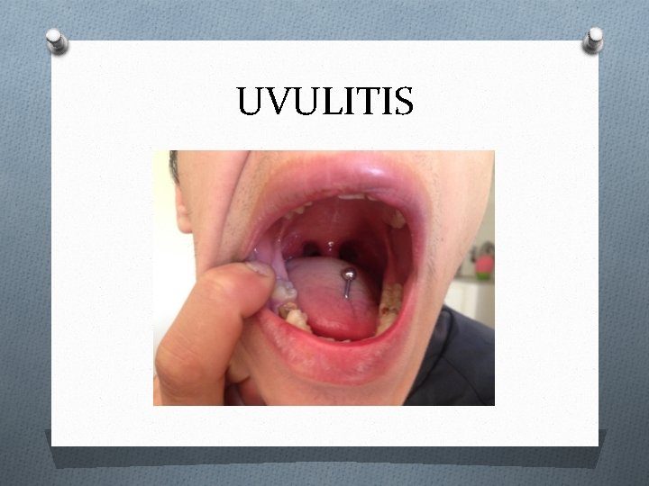 UVULITIS 