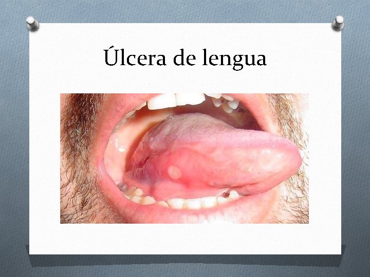 Úlcera de lengua 