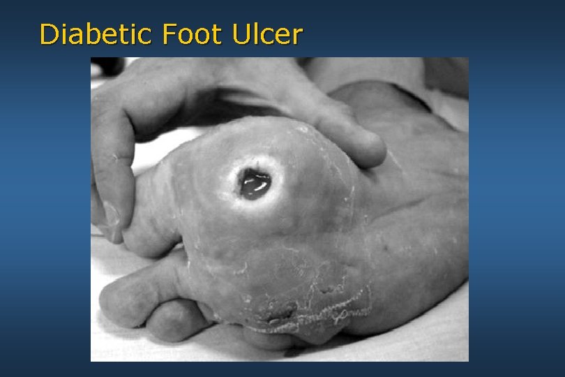 Diabetic Foot Ulcer 