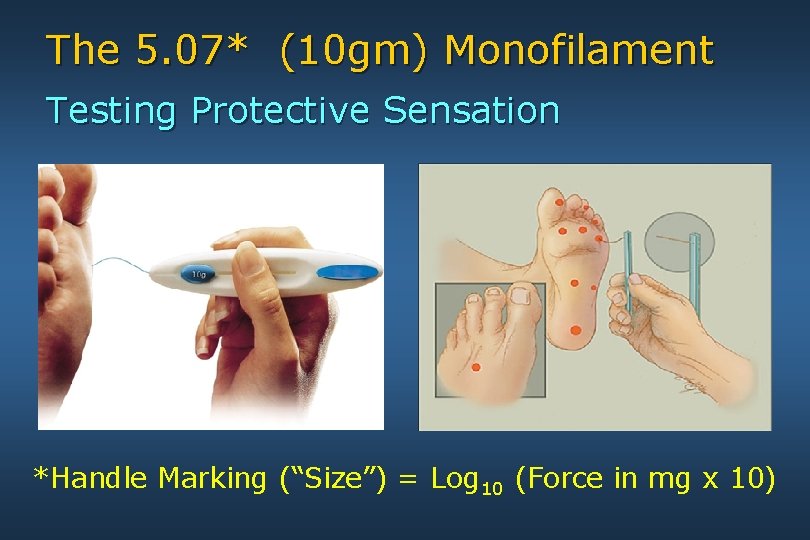 The 5. 07* (10 gm) Monofilament Testing Protective Sensation *Handle Marking (“Size”) = Log