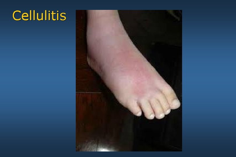 Cellulitis 