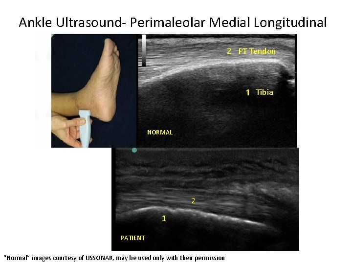 Ankle Ultrasound- Perimaleolar Medial Longitudinal PT Tendon Tibia NORMAL 2 1 PATIENT “Normal” images
