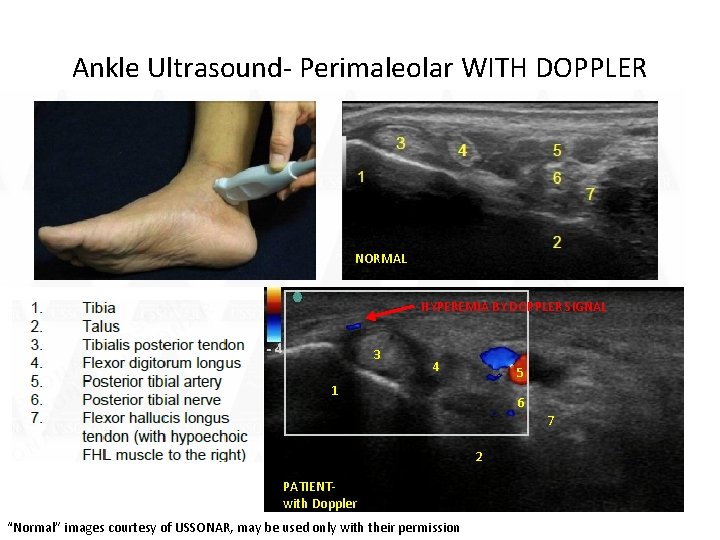Ankle Ultrasound- Perimaleolar WITH DOPPLER NORMAL HYPEREMIA BY DOPPLER SIGNAL 3 4 5 1