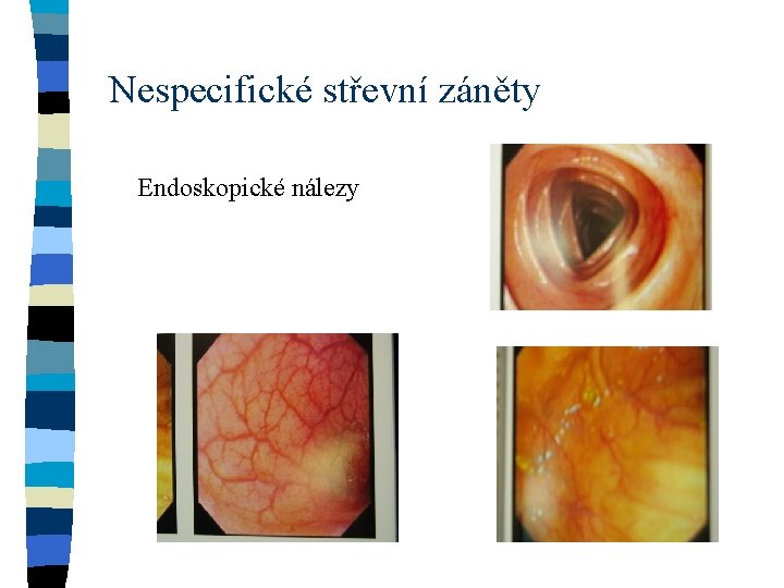 Nespecifické střevní záněty Endoskopické nálezy 