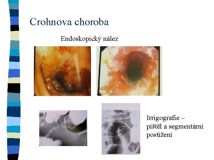Crohnova choroba Endoskopický nález Irrigografie – píštěl a segmentární postižení 
