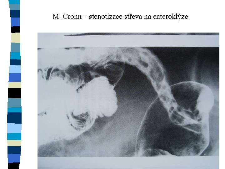 M. Crohn – stenotizace střeva na enteroklýze 