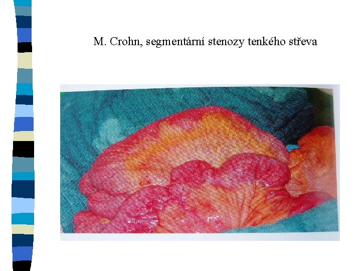 M. Crohn, segmentární stenozy tenkého střeva 