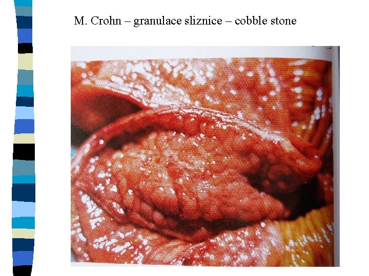 M. Crohn – granulace sliznice – cobble stone 