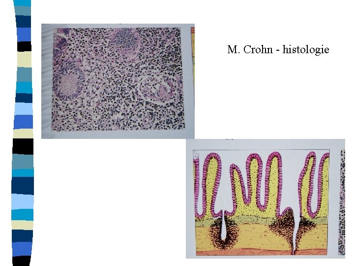 M. Crohn - histologie 