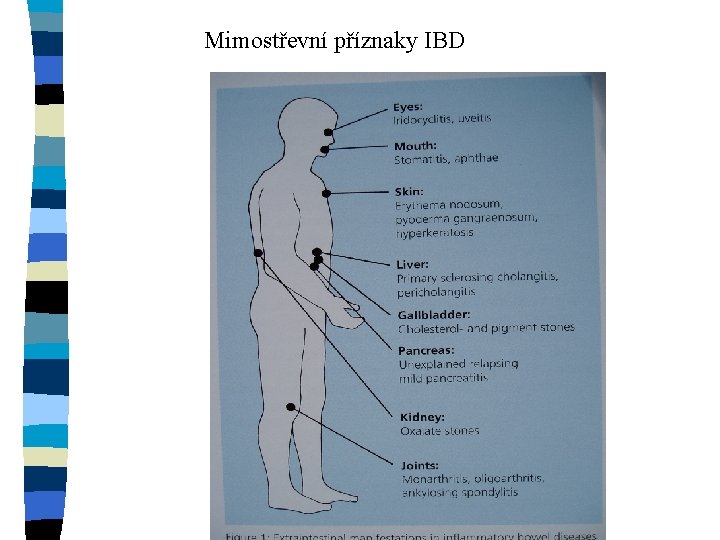 Mimostřevní příznaky IBD 