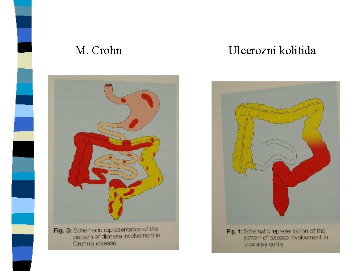 M. Crohn Ulcerozní kolitida 