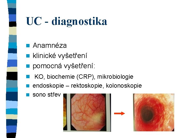 UC - diagnostika Anamnéza n klinické vyšetření n pomocná vyšetření: n n KO, biochemie