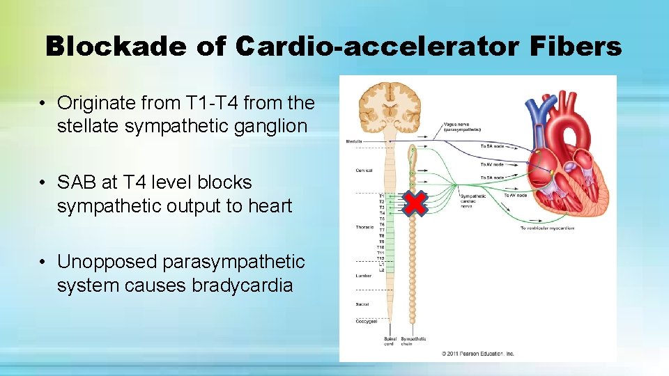 Blockade of Cardio-accelerator Fibers • Originate from T 1 -T 4 from the stellate