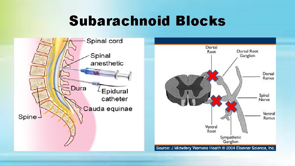 Subarachnoid Blocks 