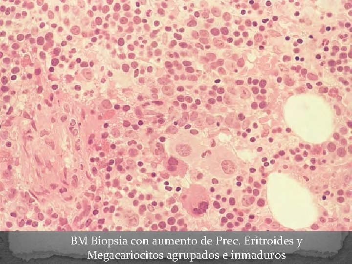 BM Biopsia con aumento de Prec. Eritroides y Megacariocitos agrupados e inmaduros 