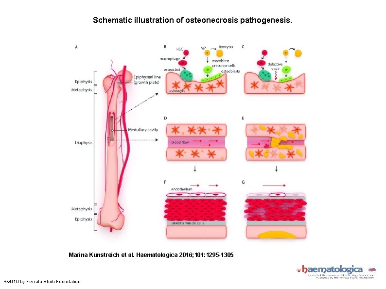 Schematic illustration of osteonecrosis pathogenesis. Marina Kunstreich et al. Haematologica 2016; 101: 1295 -1305