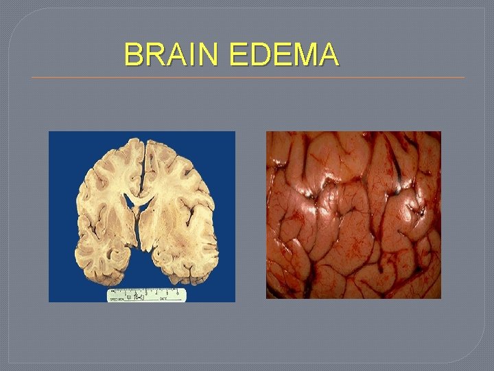 BRAIN EDEMA 