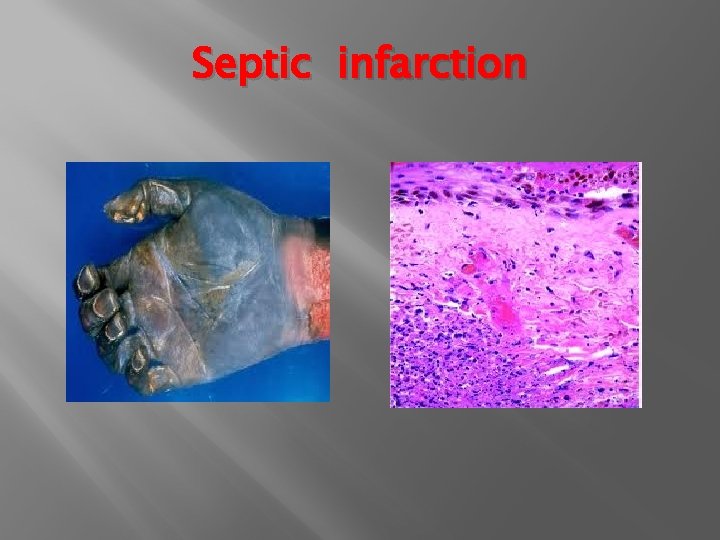 Septic infarction 