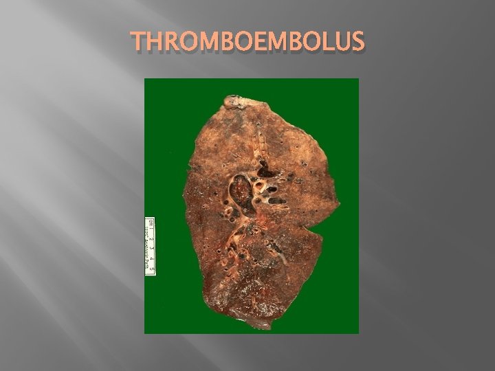 THROMBOEMBOLUS 