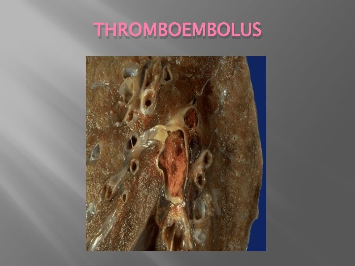 THROMBOEMBOLUS 