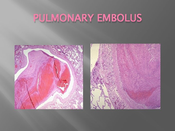 PULMONARY EMBOLUS 