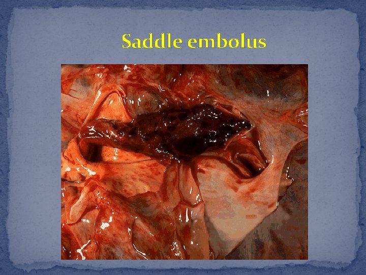 Saddle embolus 