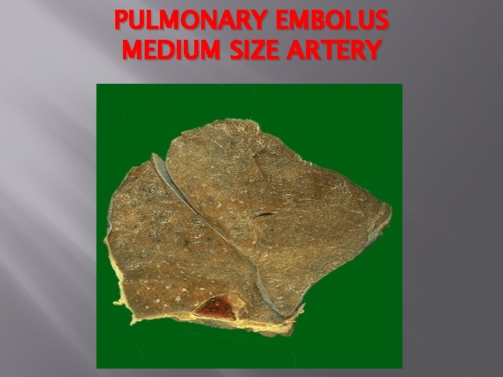 PULMONARY EMBOLUS MEDIUM SIZE ARTERY 