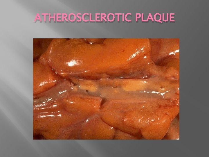 ATHEROSCLEROTIC PLAQUE 