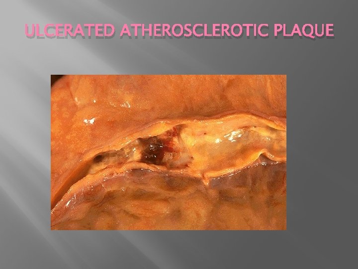 ULCERATED ATHEROSCLEROTIC PLAQUE 
