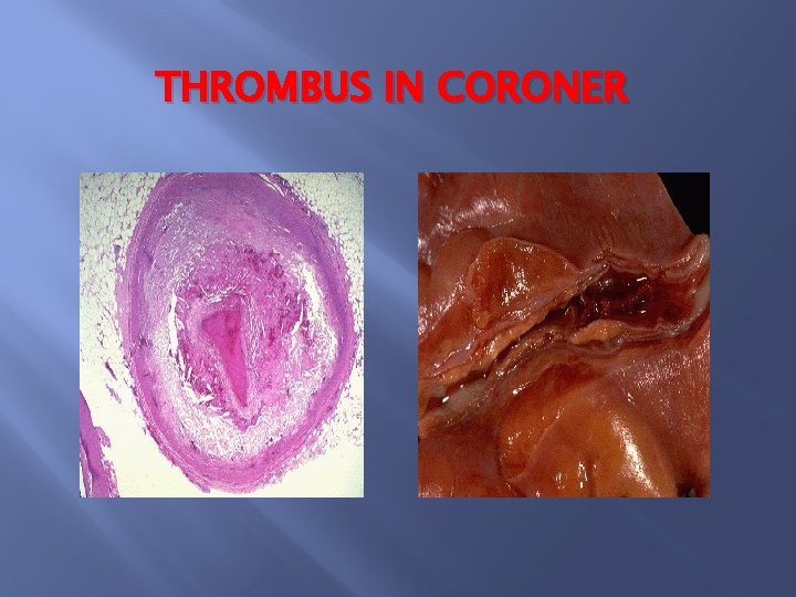 THROMBUS IN CORONER 