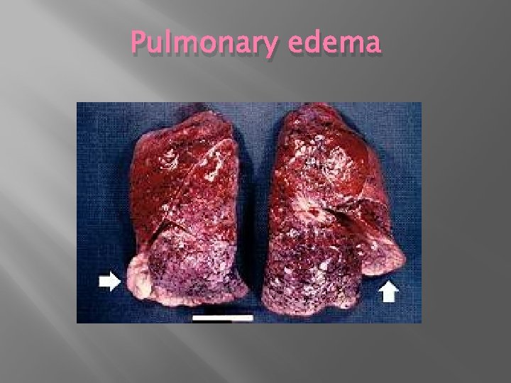 Pulmonary edema 
