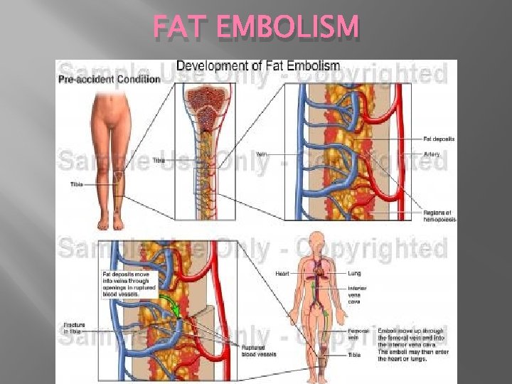 FAT EMBOLISM 