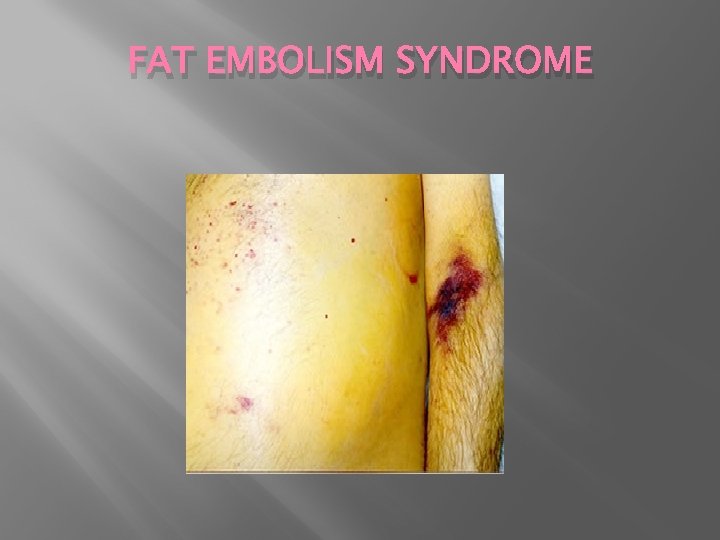FAT EMBOLISM SYNDROME 