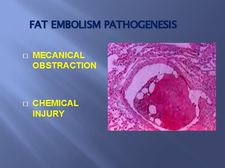 FAT EMBOLISM PATHOGENESIS � MECANICAL OBSTRACTION � CHEMICAL INJURY 