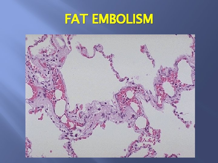 FAT EMBOLISM 