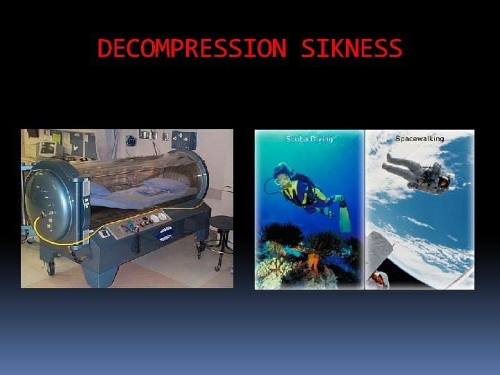 DECOMPRESSION SIKNESS 