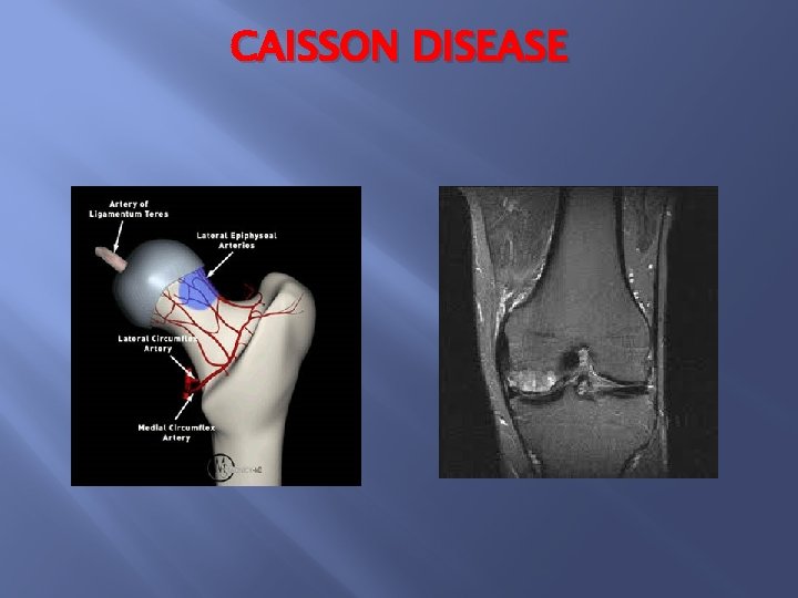 CAISSON DISEASE 
