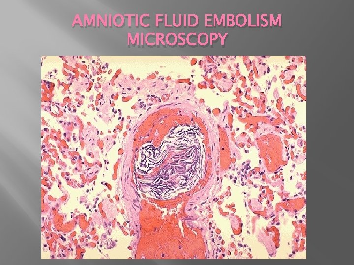 AMNIOTIC FLUID EMBOLISM MICROSCOPY 