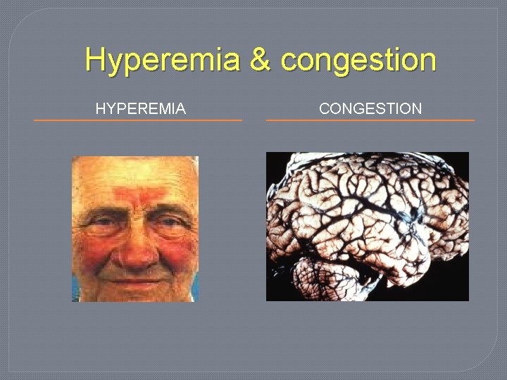 Hyperemia & congestion HYPEREMIA CONGESTION 