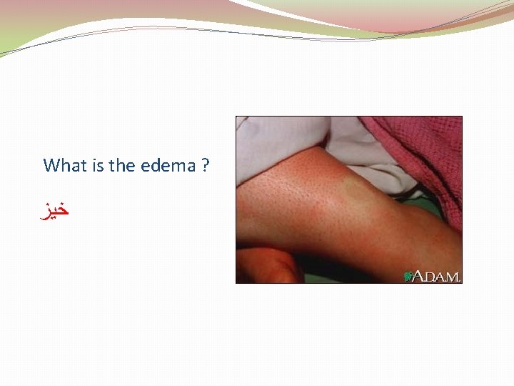 What is the edema ? ﺧﻴﺰ 
