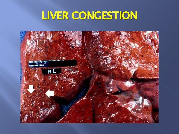 LIVER CONGESTION 