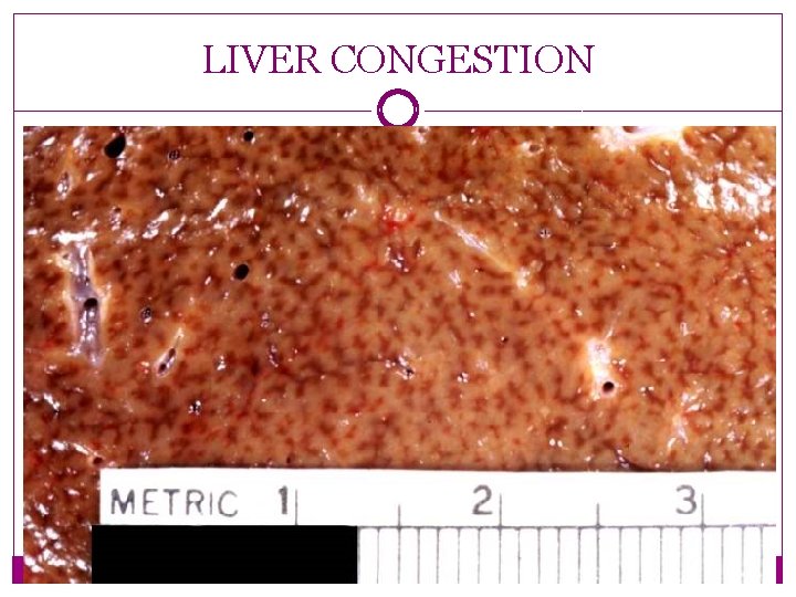 LIVER CONGESTION 
