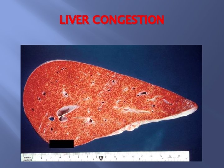 LIVER CONGESTION 